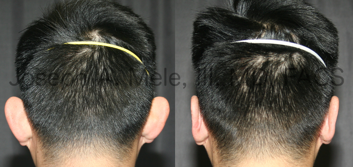 Otoplasty before and after ear pinning surgery for prominent ears