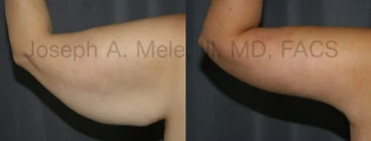 Arm Lift before and after pictures