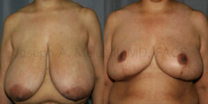 Breast Reduction for Women - before and after photos