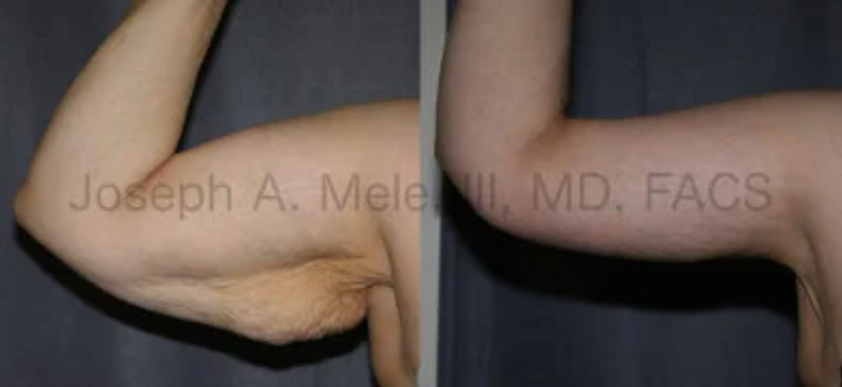 Brachioplasty before and after pictures