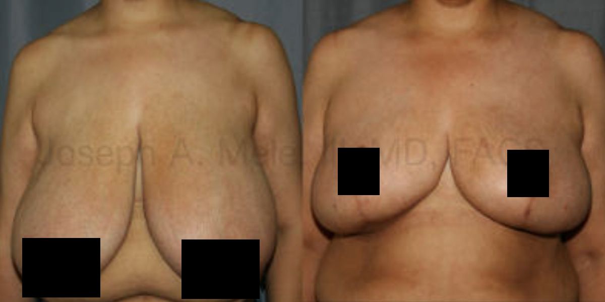 Breast Reduction for Women - before and after photos