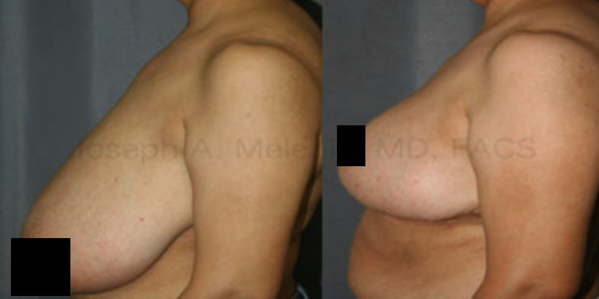 Reduction Mammoplasty for Women - before and after pictures