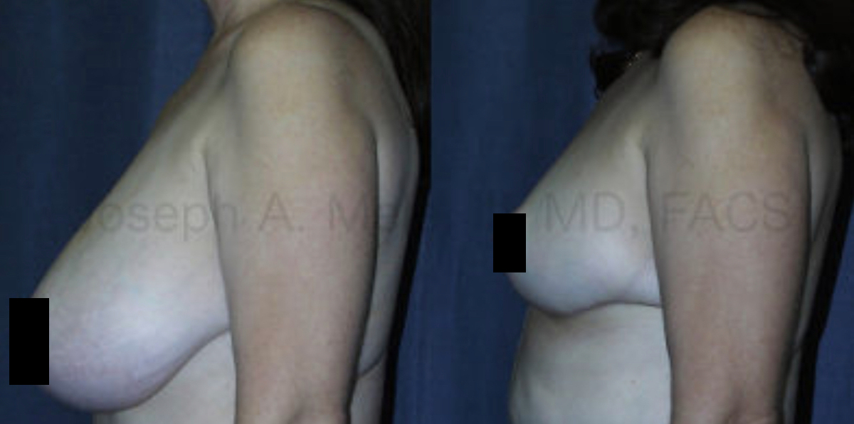 Breast Reduction for Women - before and after pictures