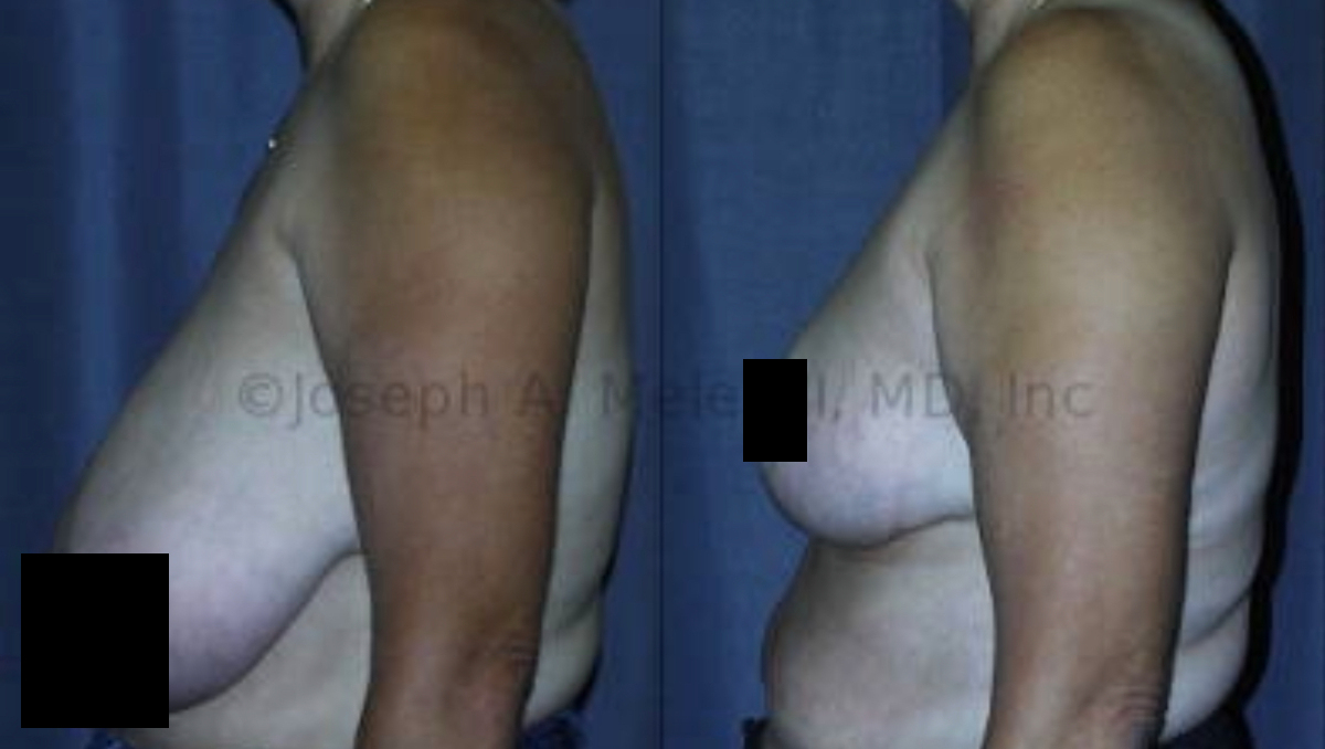 Reduction Mammoplasty for Women - before and after photos