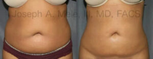 Liposuction of the abdomen and flanks