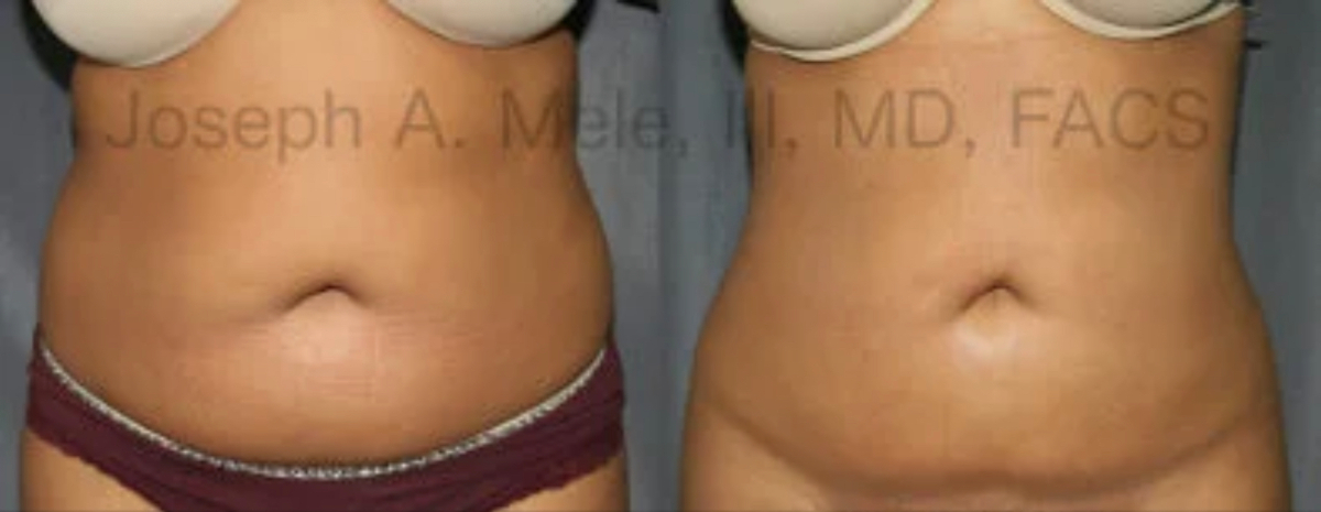 Liposuction of the abdomen and flanks