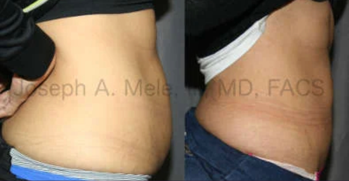 Liposuction of the abdomen