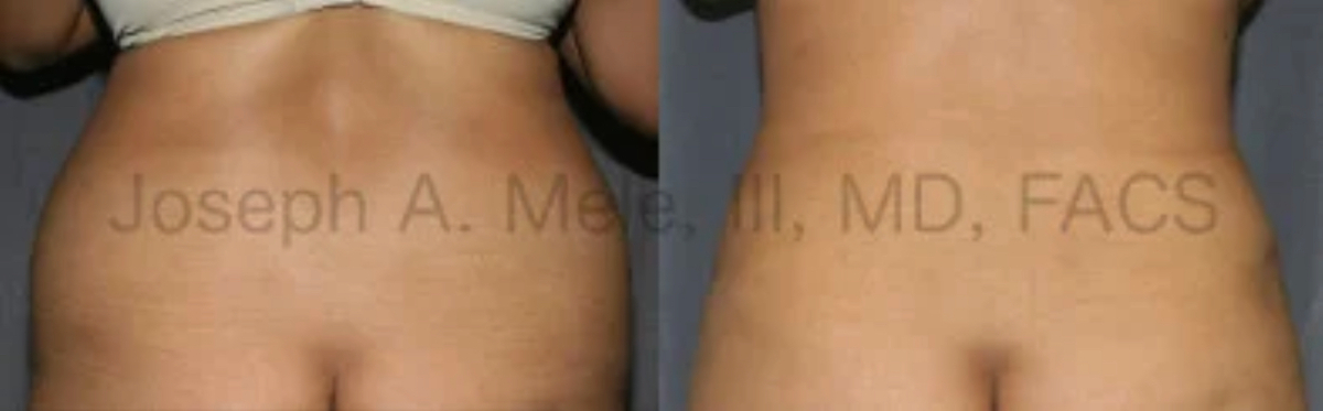 Liposuction of the back and flanks