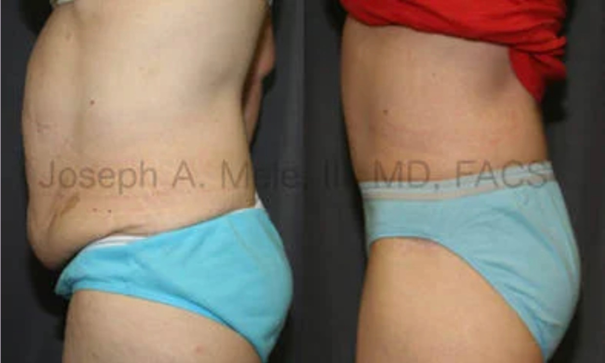 Tummy Tuck before and after pictures - Abdominoplasty