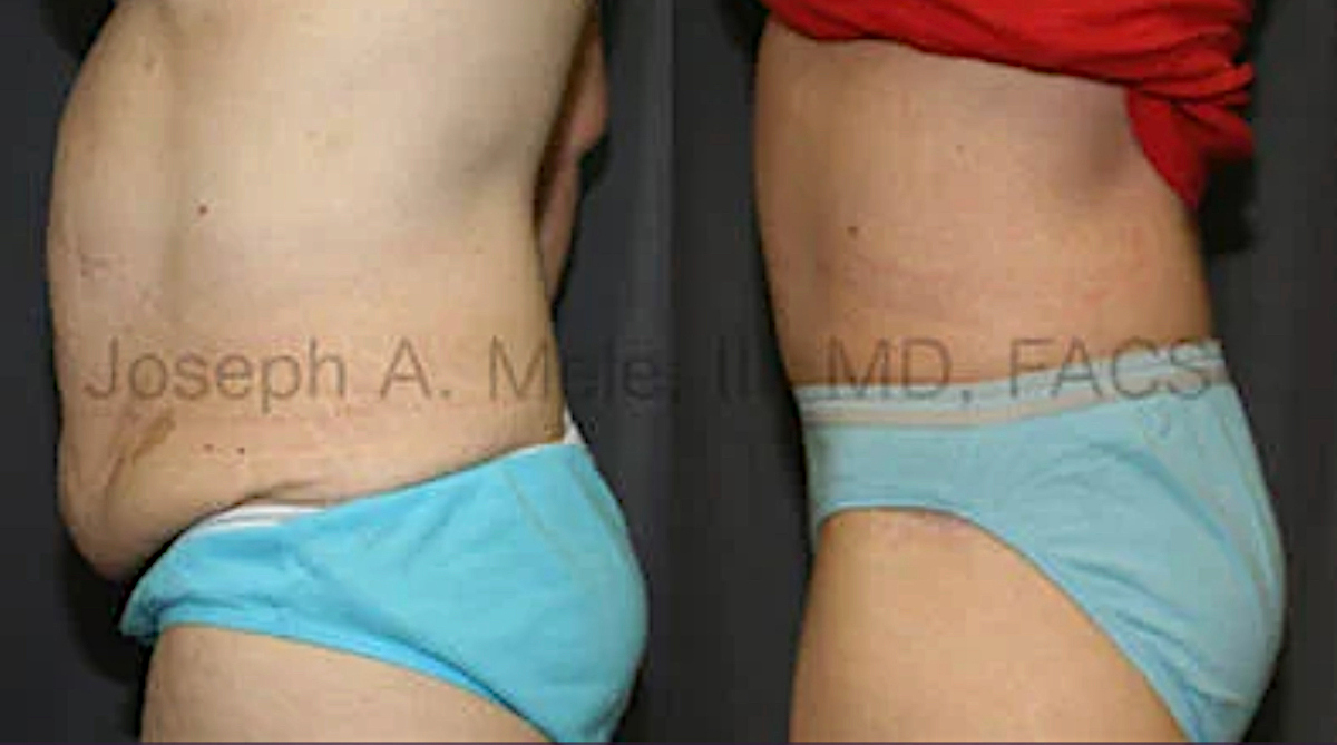 Tummy Tuck Before and After Pictures