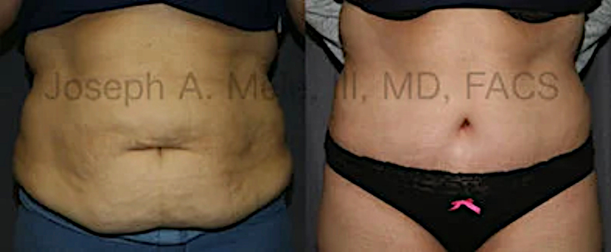 Tummy Tuck Before and After Pictures