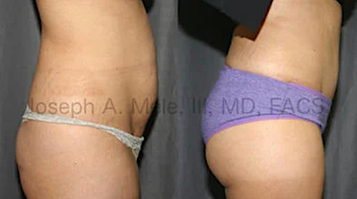 Tummy Tuck Before and After Pictures