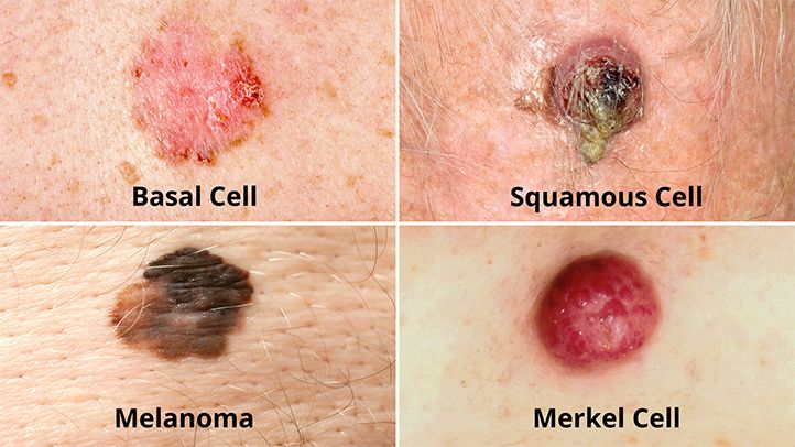 Different types of skin cancer