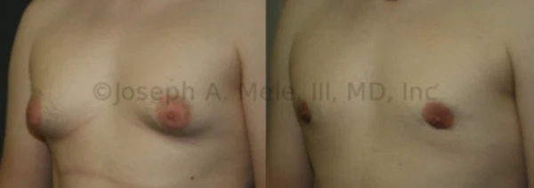 Gynecomastia reduction for large breasts with puffy nipples.
