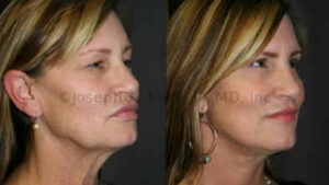 Facelift and Eyelid Lift before and after pictures (Rhytidectomy and Blepharoplasty)