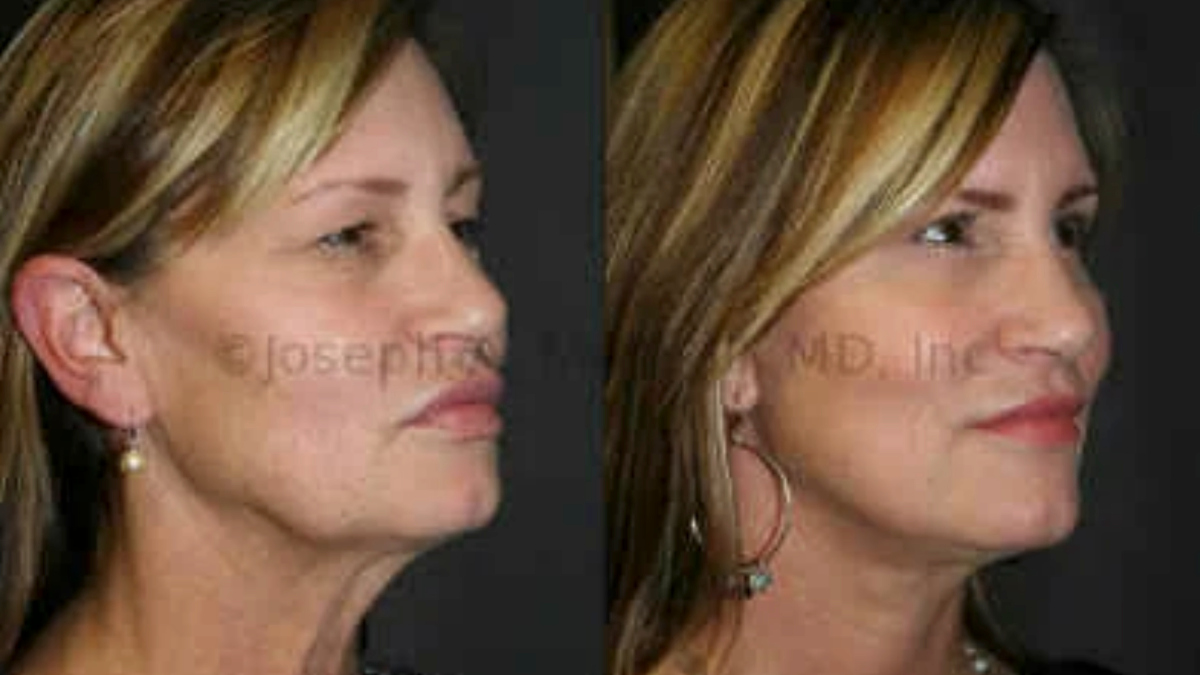 Facelift and Eyelid Lift before and after pictures (Rhytidectomy and Blepharoplasty)