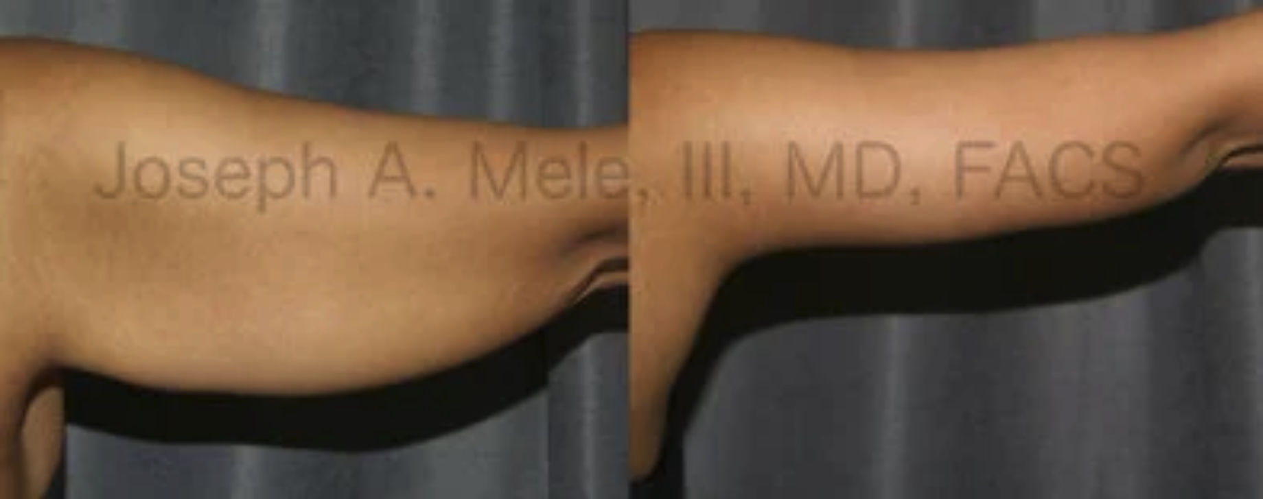 Arm Lift Before and After Pictures (Brachioplasty)