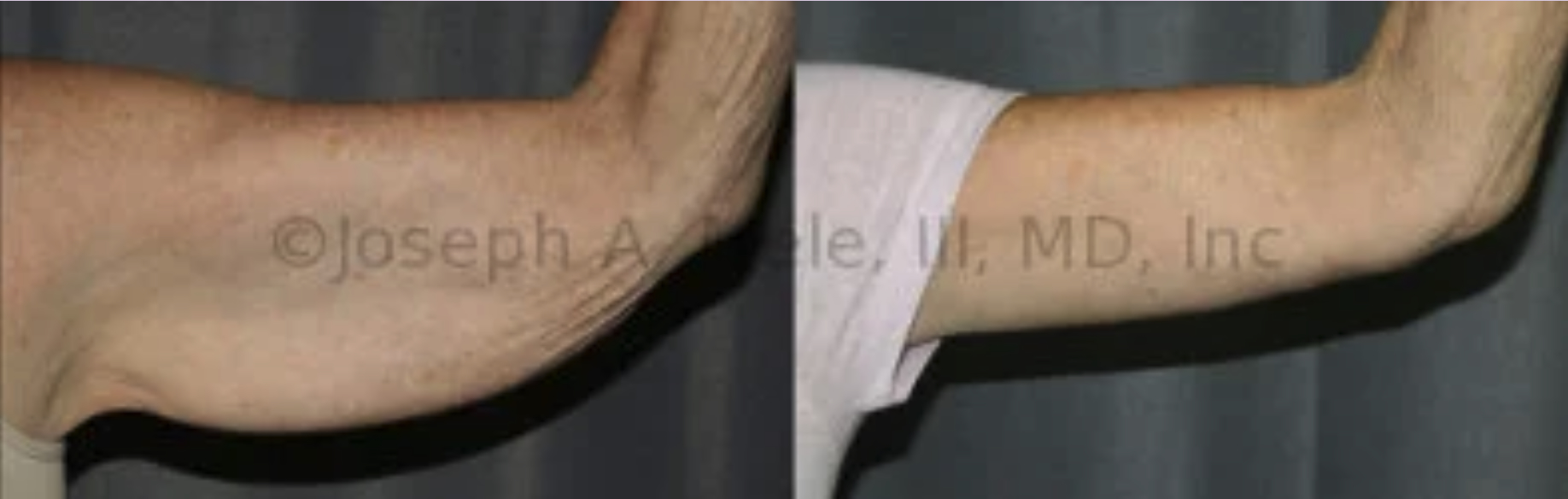 Arm Lift Before and After Pictures (Brachioplasty)