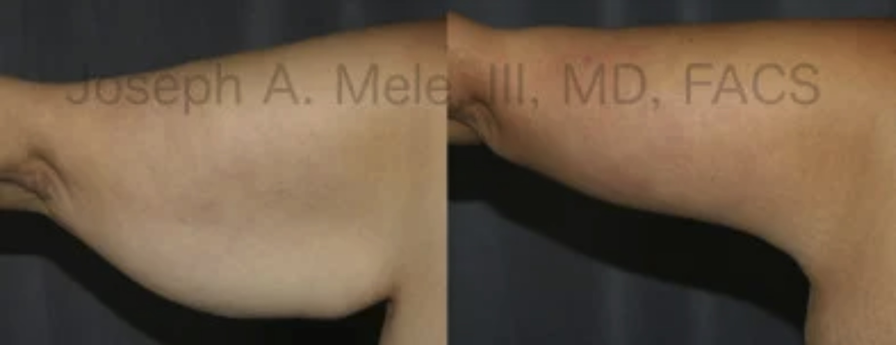 Arm Lift Before and After Pictures (Brachioplasty)