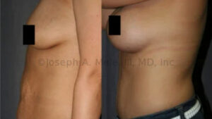 Tummy Tuck Mommy Makeover before and after photos