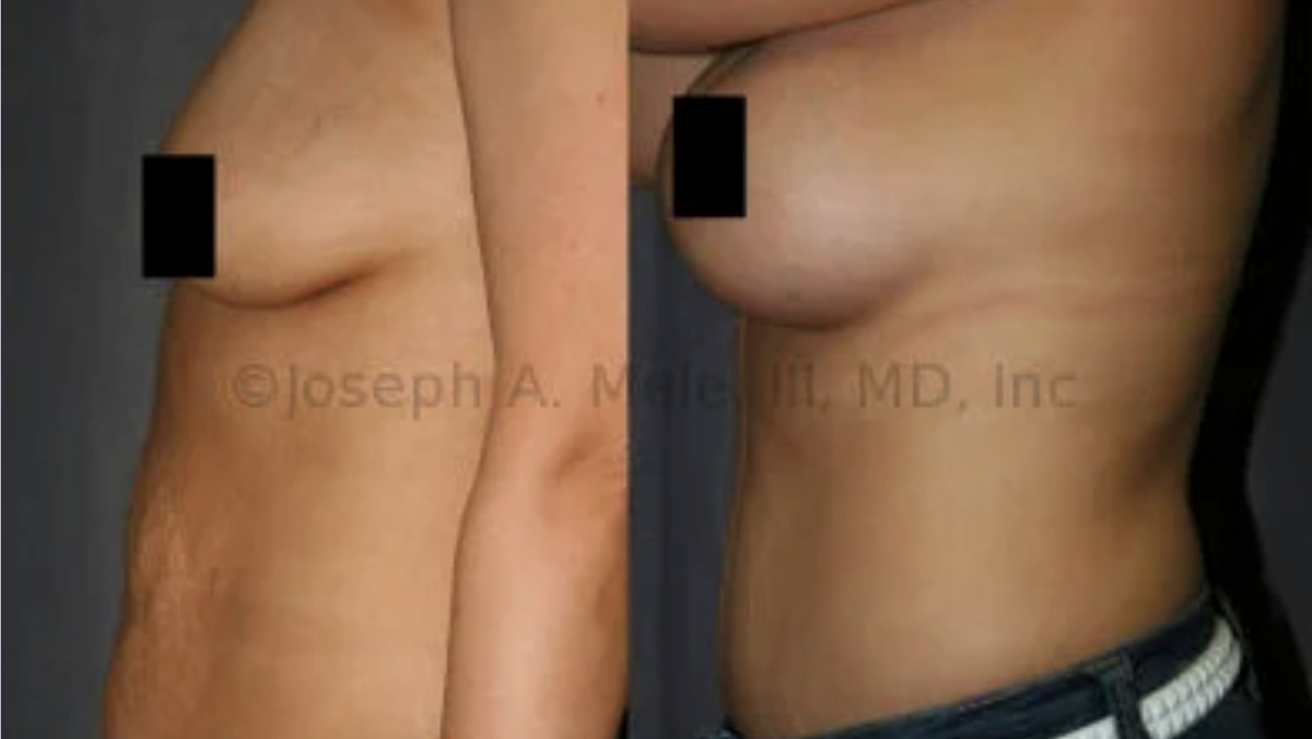 Tummy Tuck Mommy Makeover before and after photos