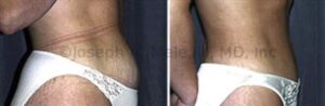 Tummy Tuck Before and After Pictures Abdominoplasty