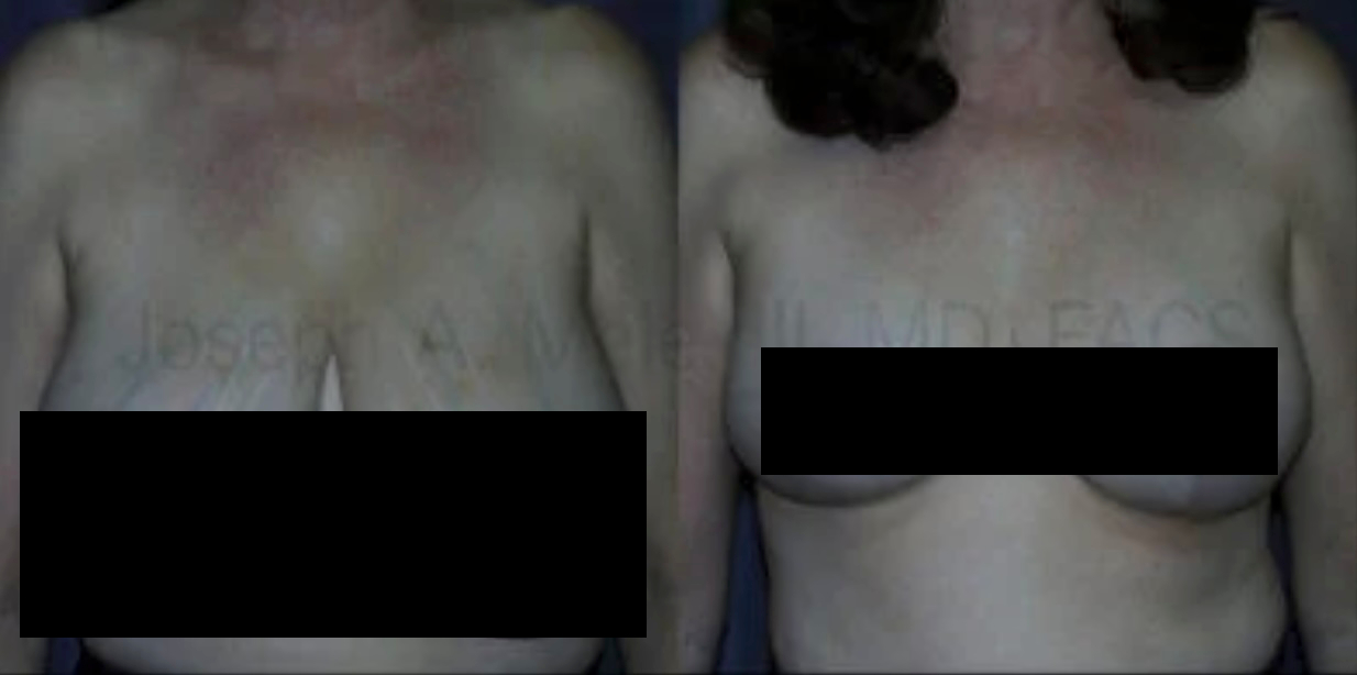 Female Breast Reduction Before and After (censored)