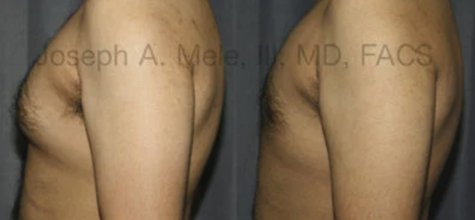 Male Breast Reduction for Gynecomastia