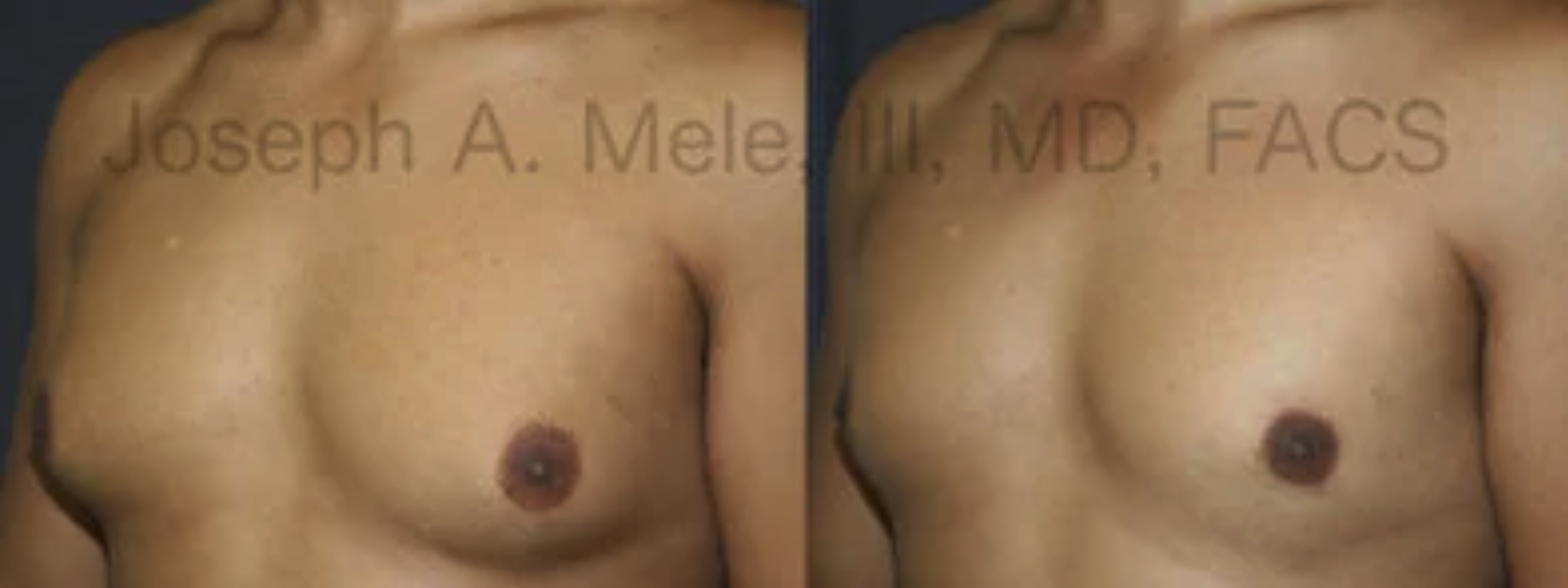 Gynecomastia Reduction Surgery for Man Boobs