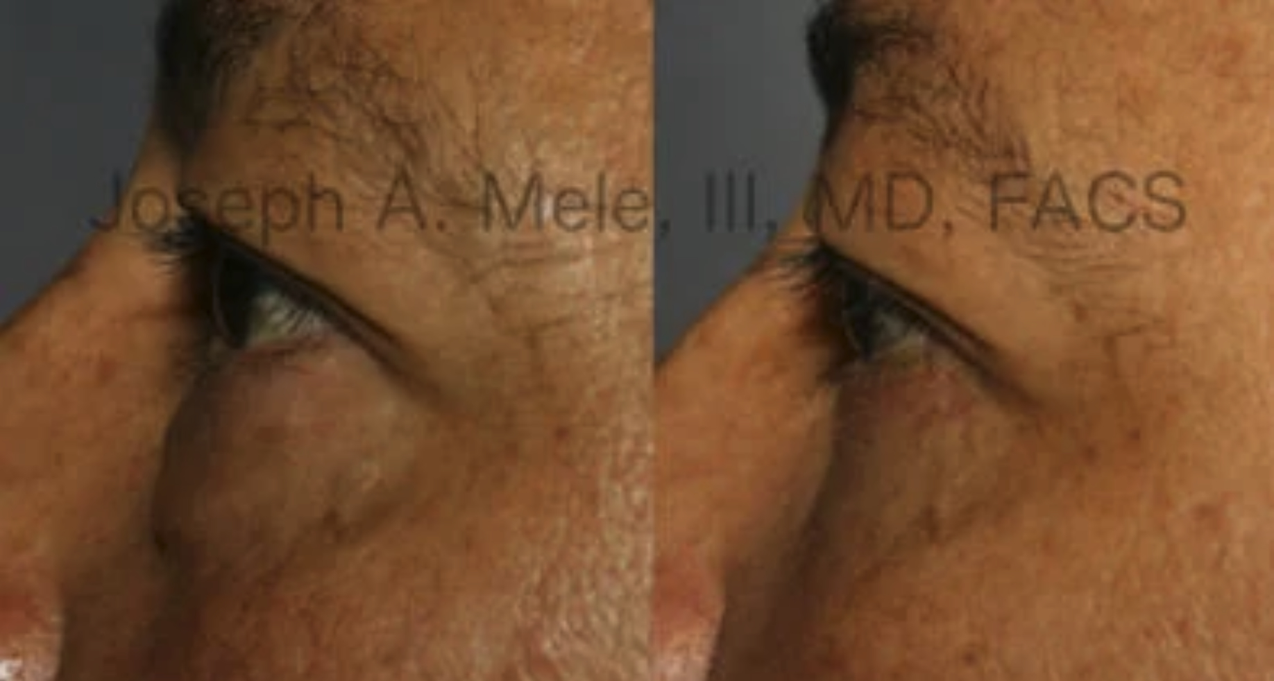 Lower eyelid lift before and after photos - lower blepharoplasty SF Bay Area