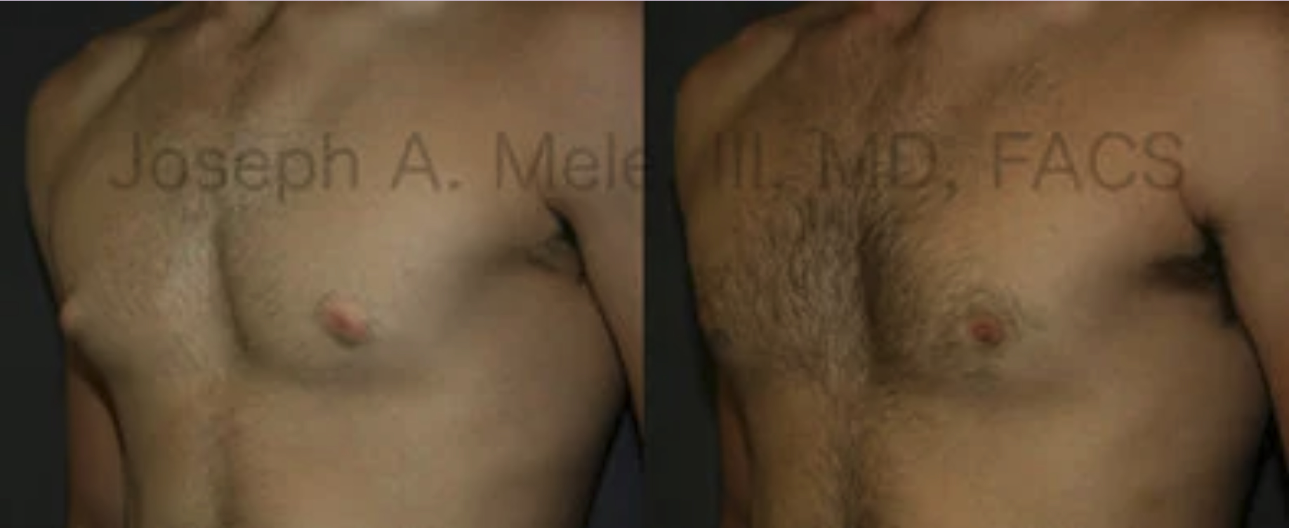 Puffy nipple reduction before and after pictures (male)