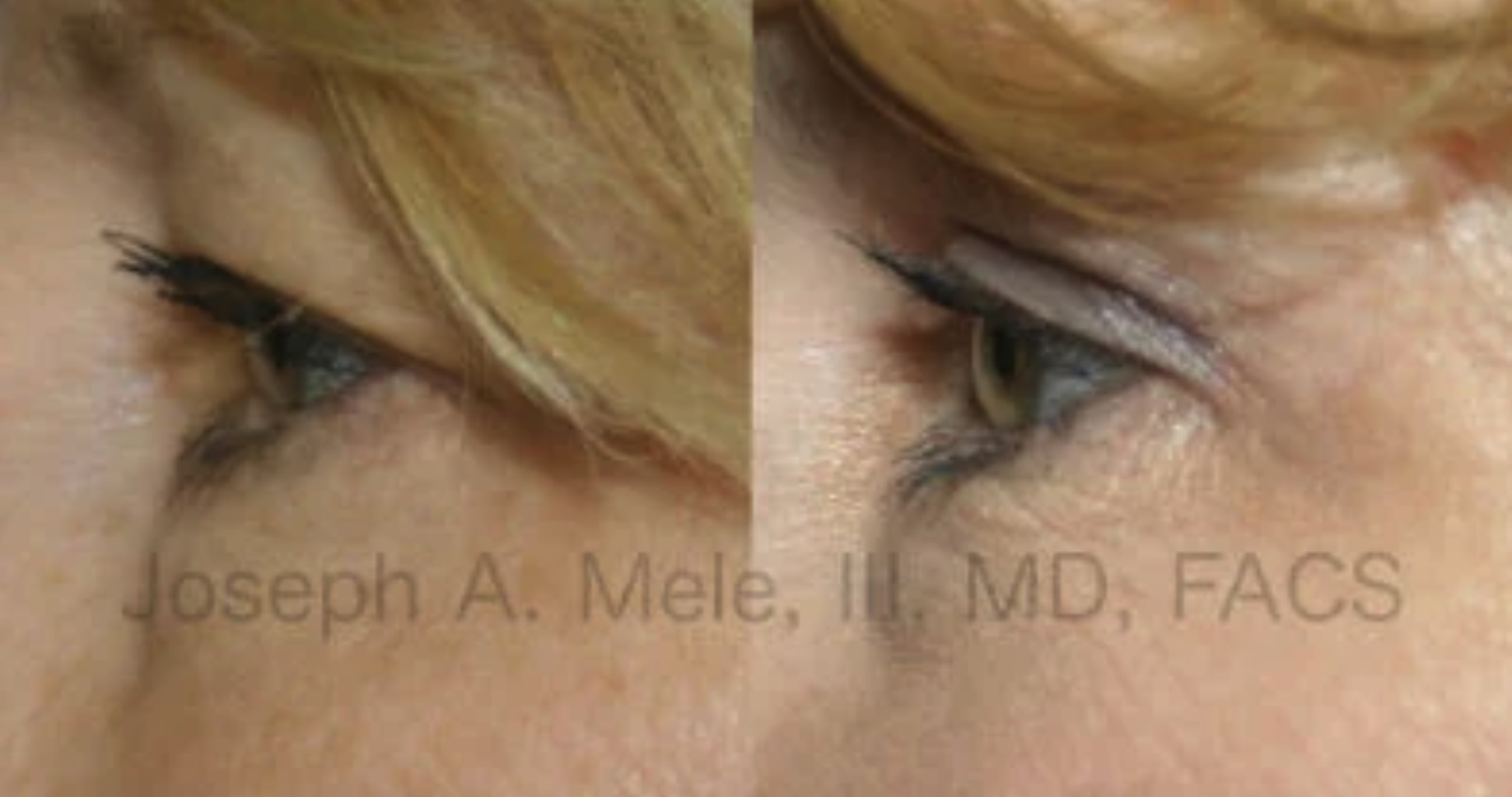 Upper and Lower Eyelid Lift - Blepharoplasty SF Bay Area