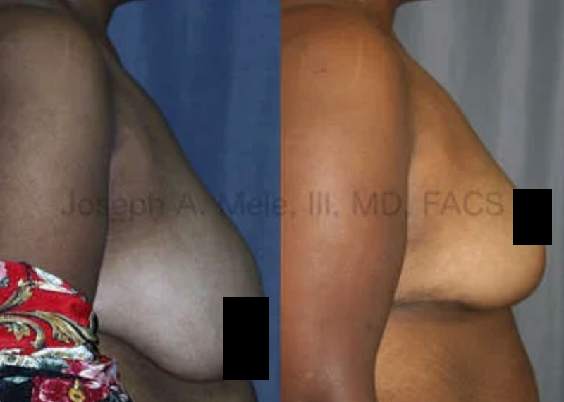 Reduction Mammoplasty Before and After Pictures (censored)