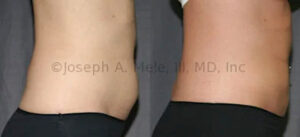 Lipo 360 before and after pictures - liposuction