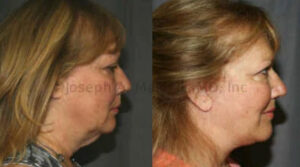 Face Lift before and after pictures