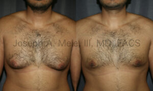 Gynecomastia Reduction (Male Breast Reduction) Before and After Photos