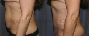 Tummy Tuck Before and After Pictures (Abdominoplasty)