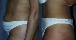 Tummy Tuck Before and After Pictures (Abdominoplasty)