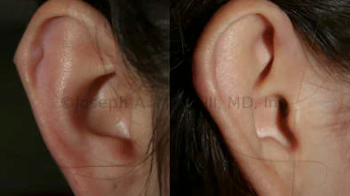 Otoplasty for piercing injury before and after pictures