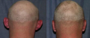 Otoplasty for prominent ears in an adult before and after pictures