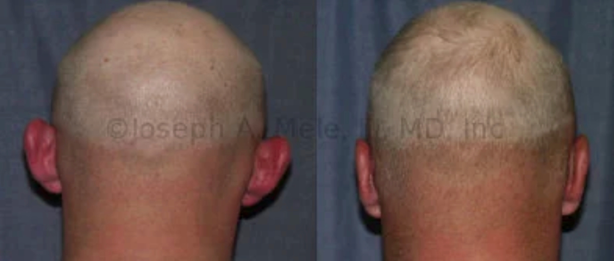 Otoplasty for prominent ears in an adult before and after pictures