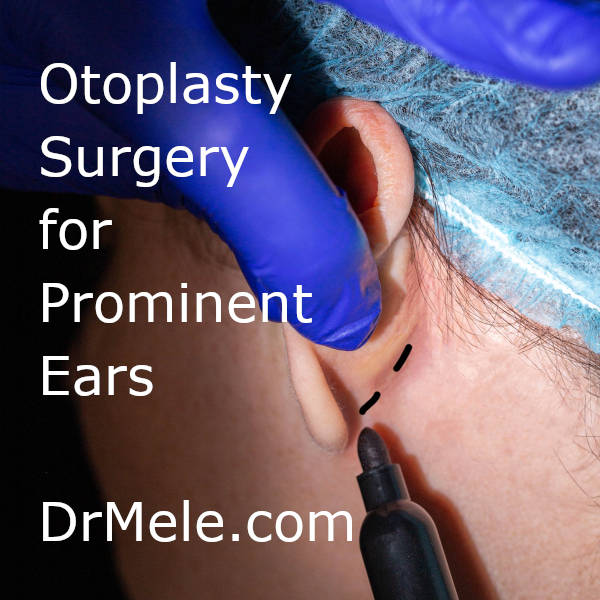 SF Bay Area Otoplasty Before and After Pictures