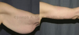Arm Lift Before and After Pictures (Brachioplasty)