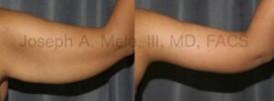 Arm Lift Before and After Pictures (Brachioplasty)