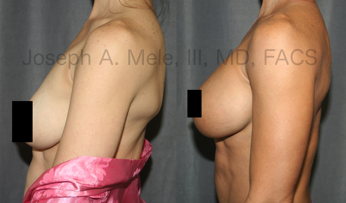 Breast Augmentation before and after pictures (censored)