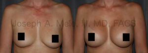 Breast Augmentation before and after photos (censored)