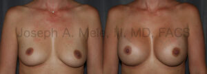 Breast Augmentation before and after photos (uncensored)