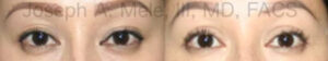 Double eyelid surgery before and after pictures for Asian eyelids