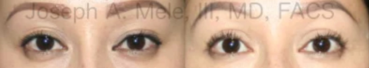 Double eyelid surgery before and after pictures for Asian eyelids