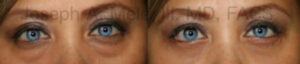 Lower eyelid before and after pictures lower blepharoplasty